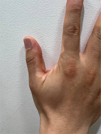 アトピー性皮膚炎