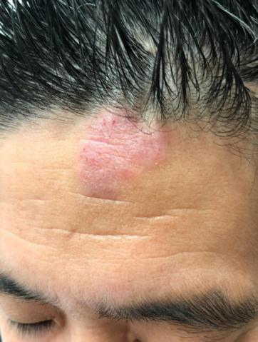 アトピー性皮膚炎