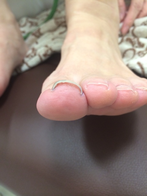 巻き爪の写真