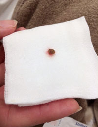 皮膚がん・ほくろがんの治療6